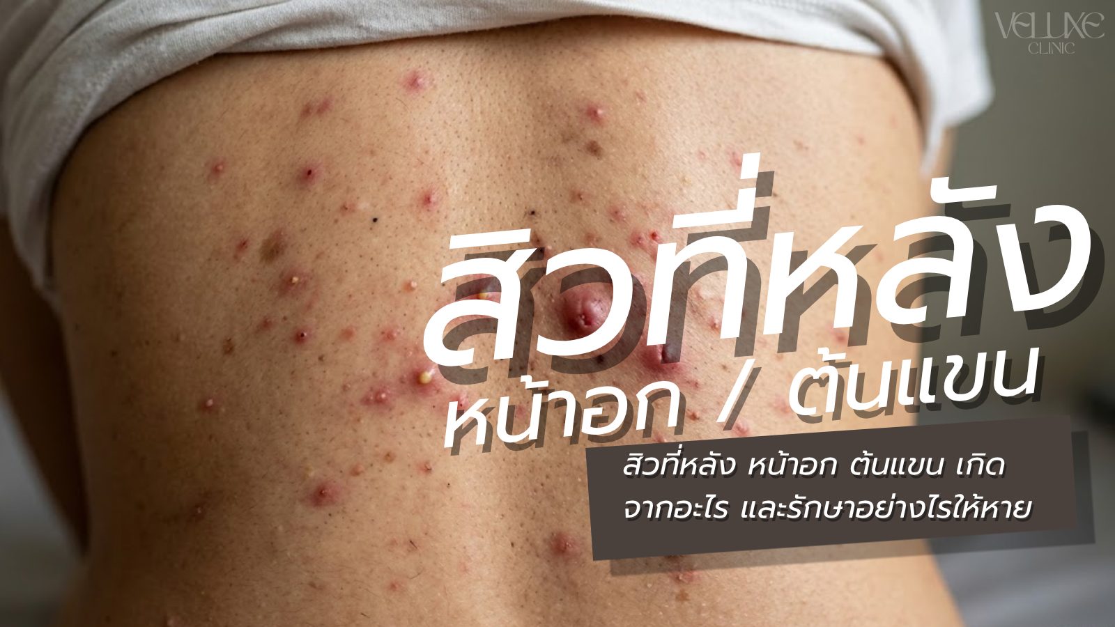 สิวที่หลัง หน้าอก ต้นแขน