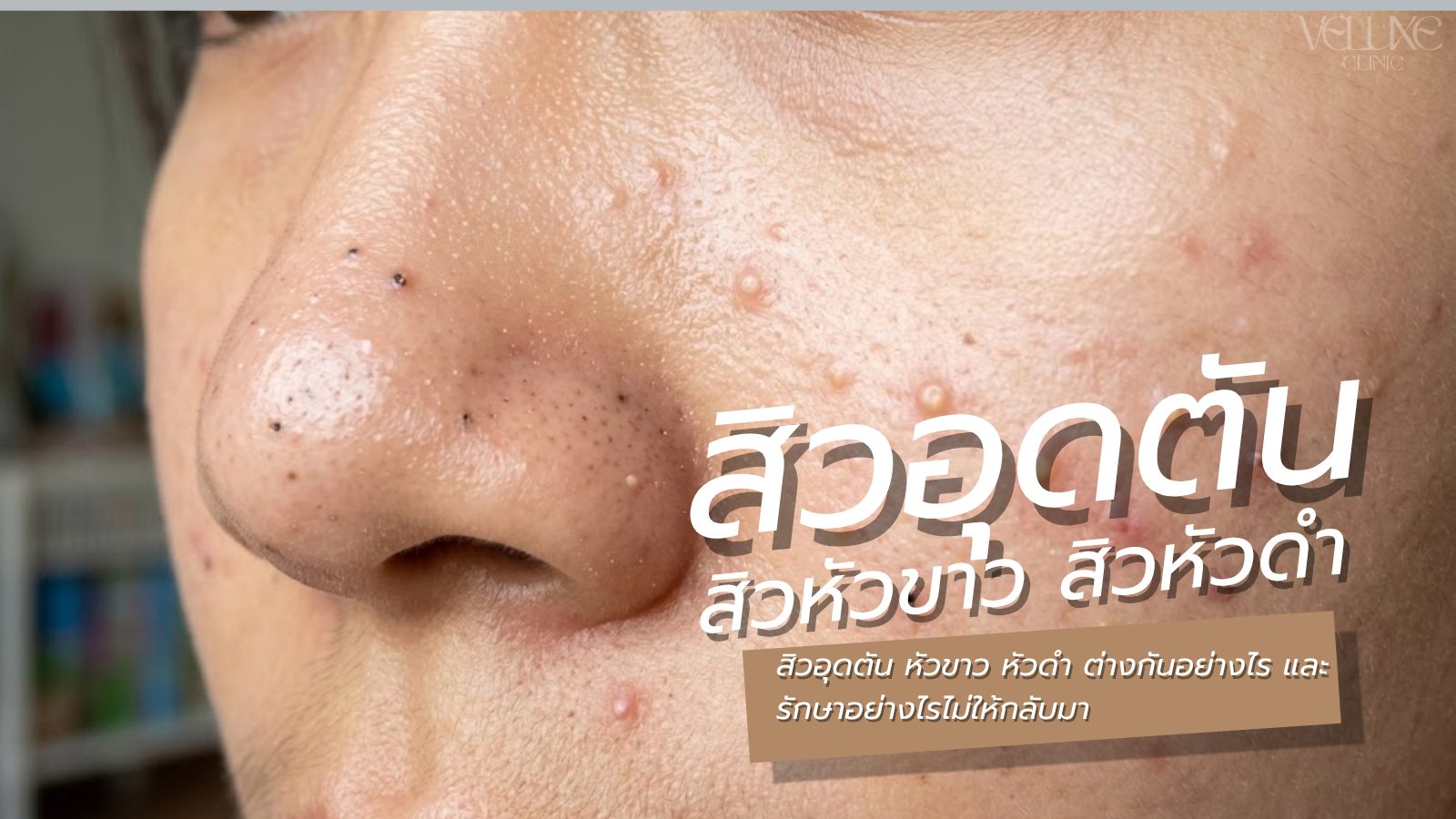 สิวอุดตัน หัวขาว หัวดำ