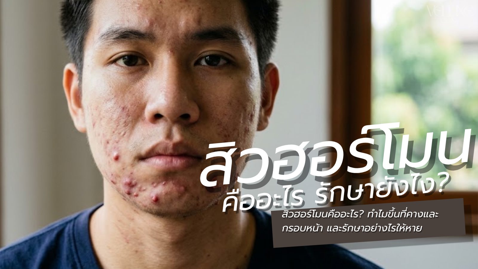 สิวฮอร์โมนคืออะไร