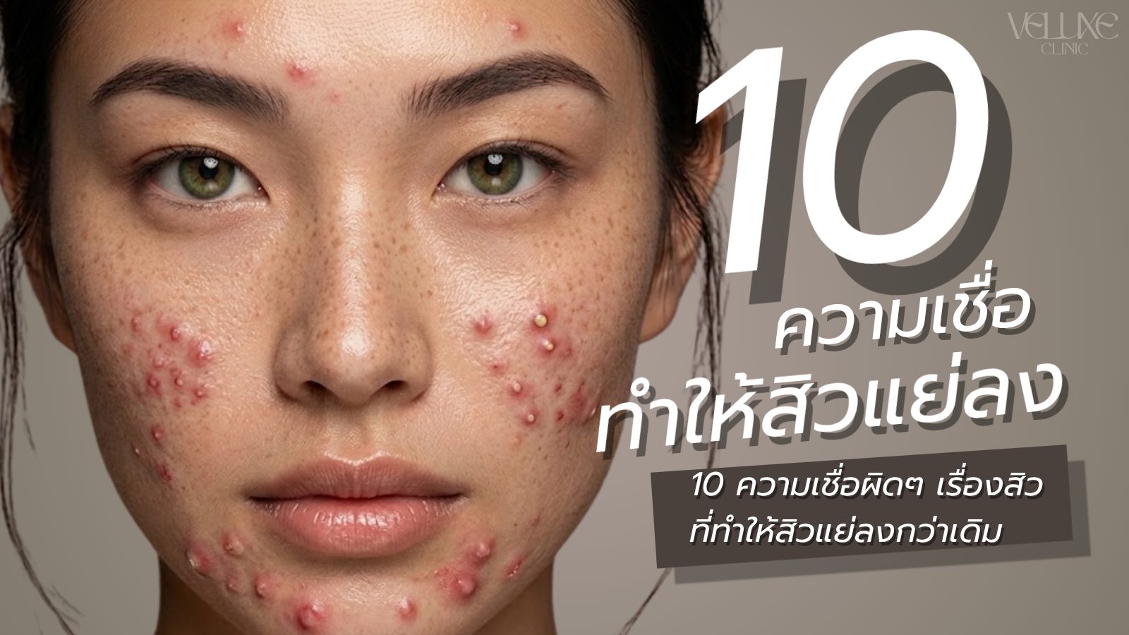 10 ความเชื่อผิดๆ เรื่องสิว