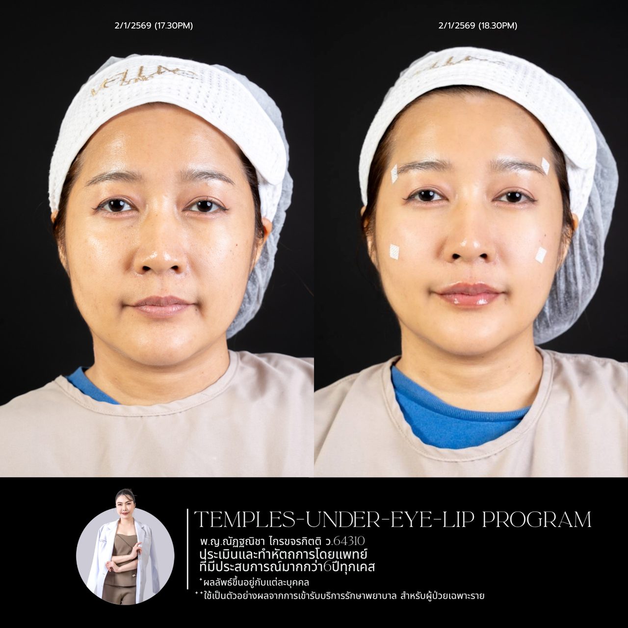 Filler ขมับ