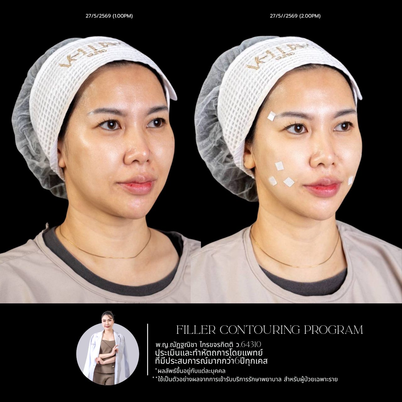 Filler ขมับ