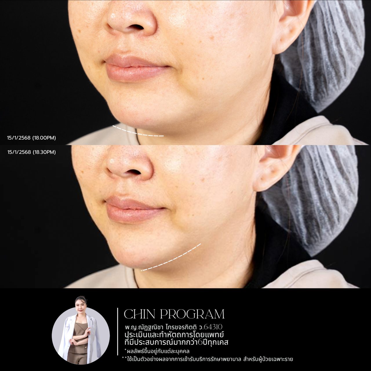 Filler คาง