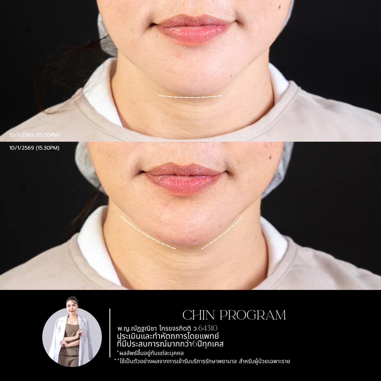 Filler คาง