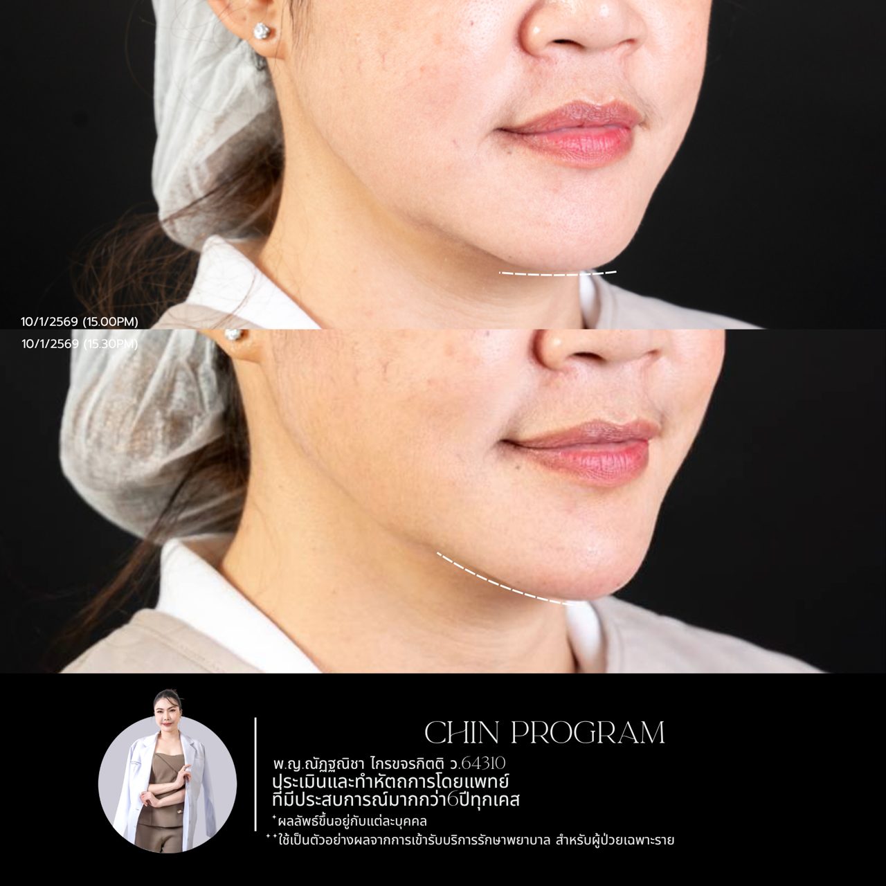 Filler คาง