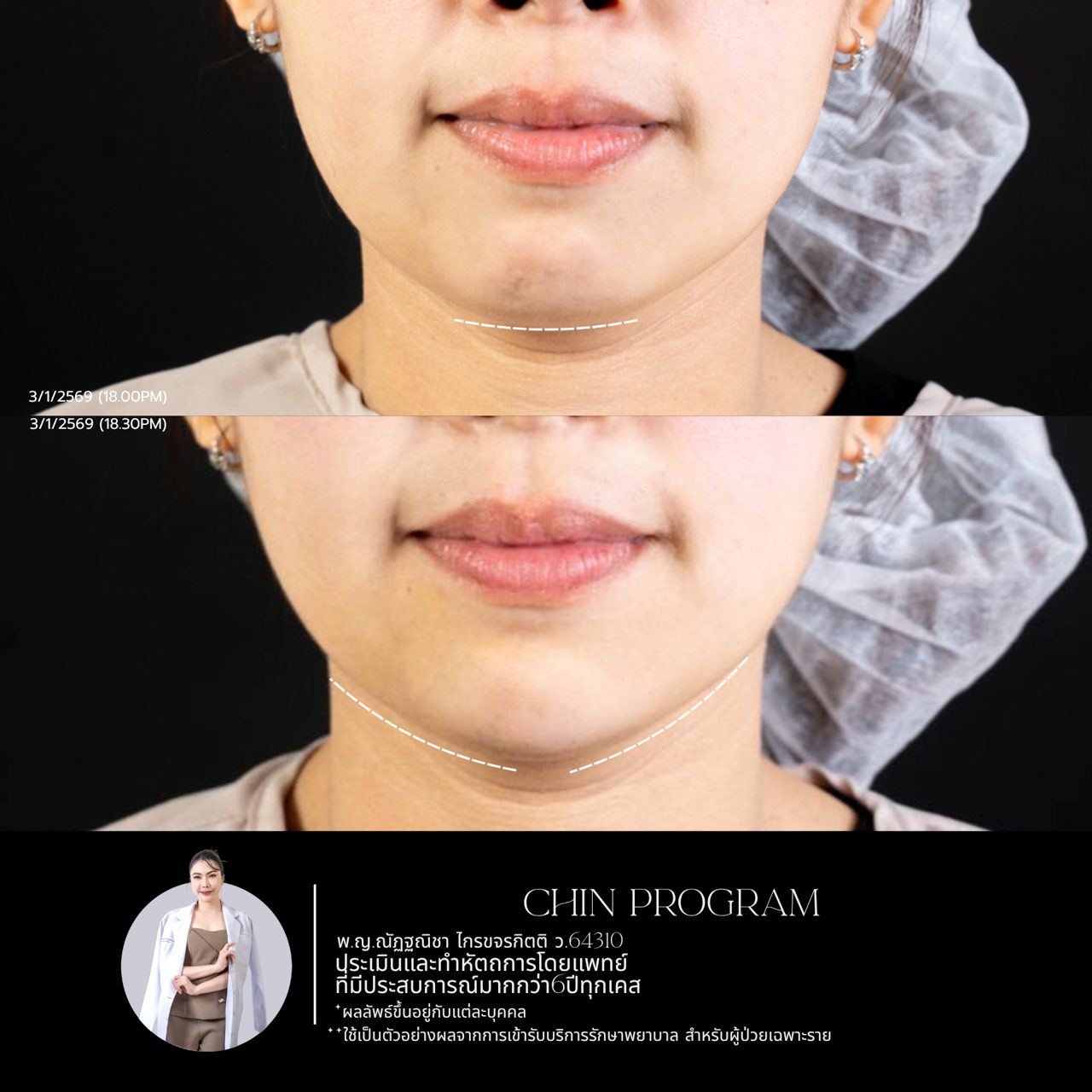 Filler คาง