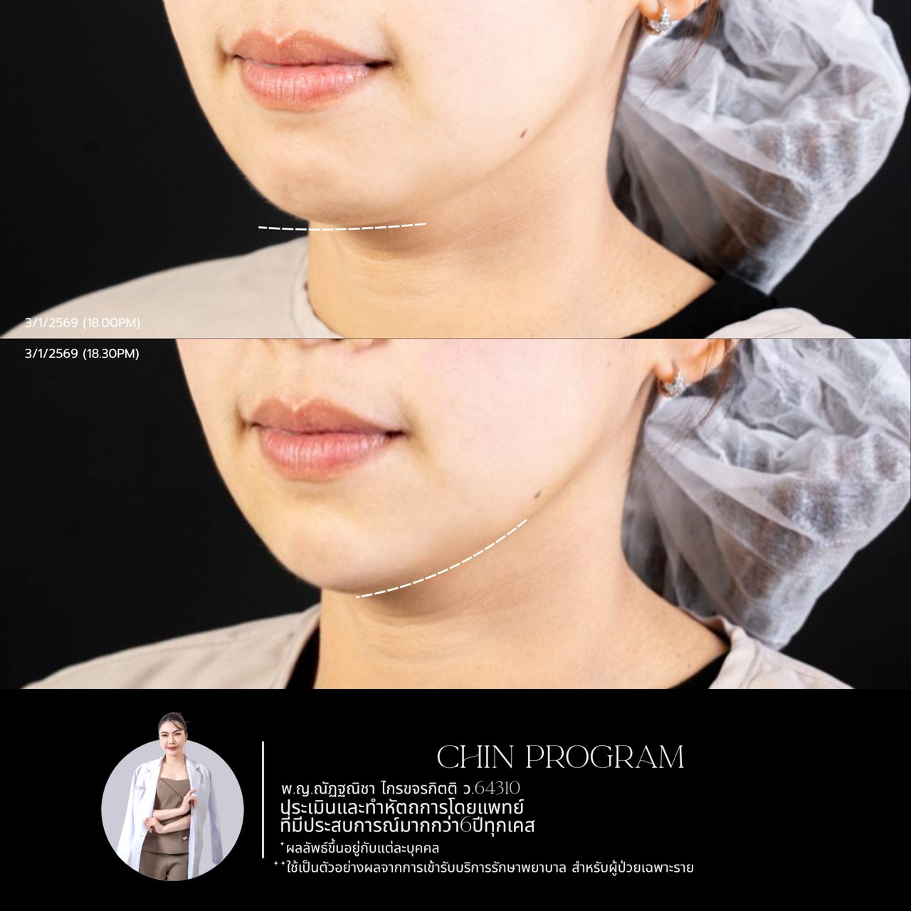 Filler คาง