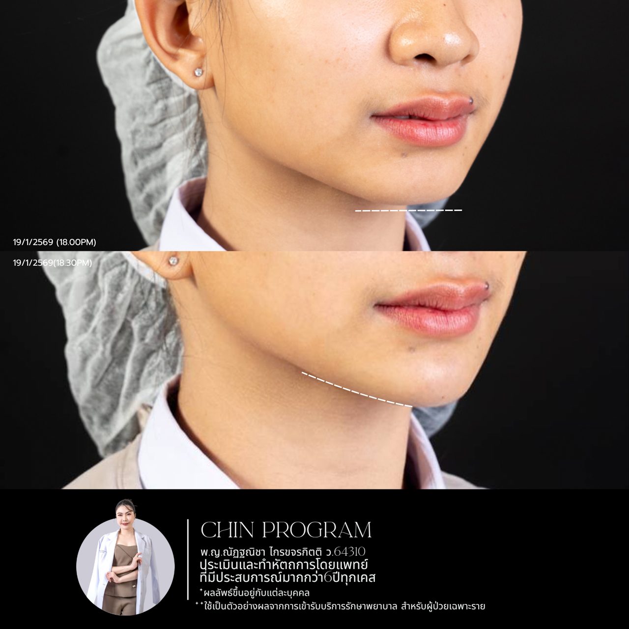 Filler คาง