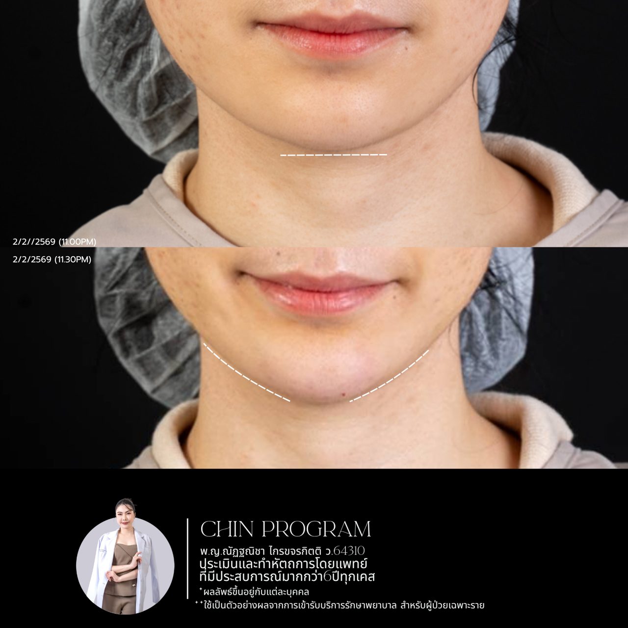 Filler คาง