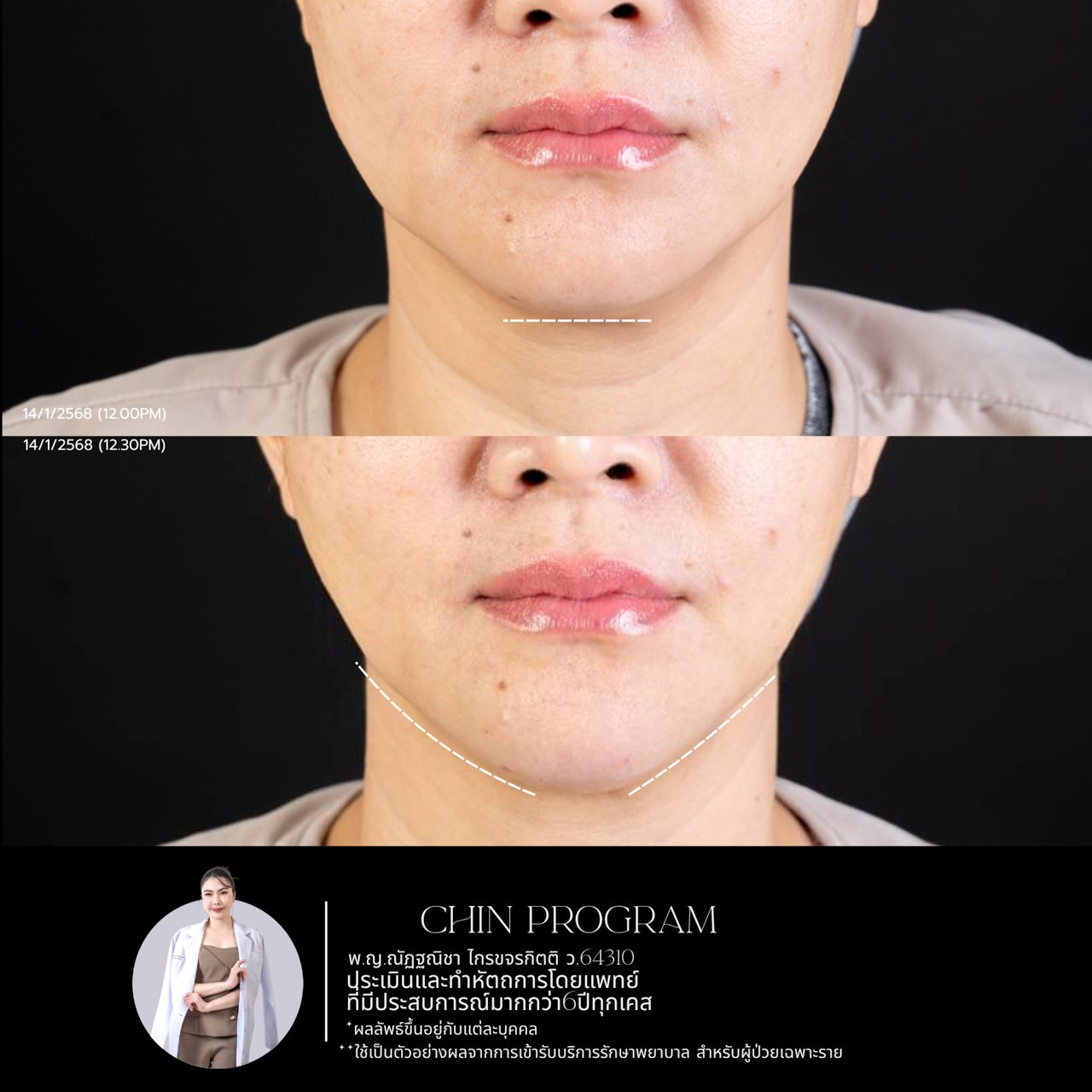 Filler คาง