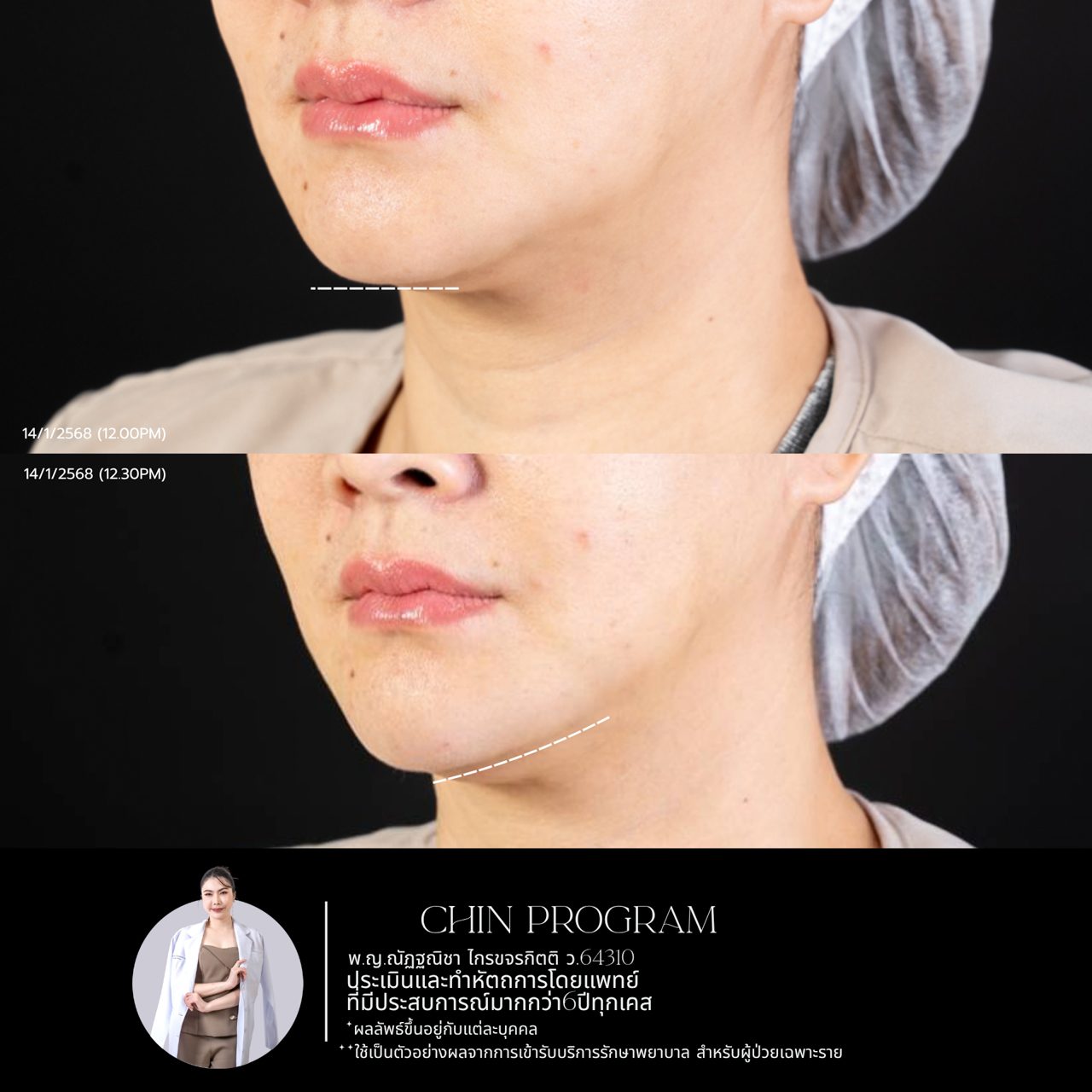 Filler คาง