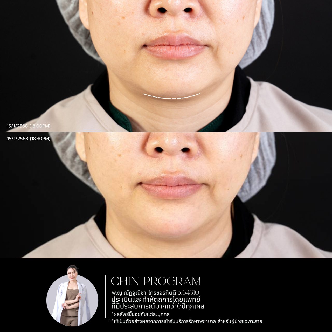 Filler คาง