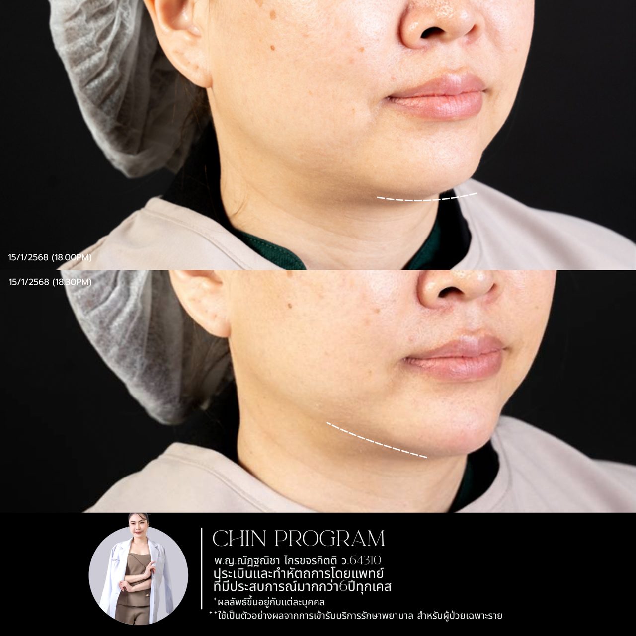 Filler คาง