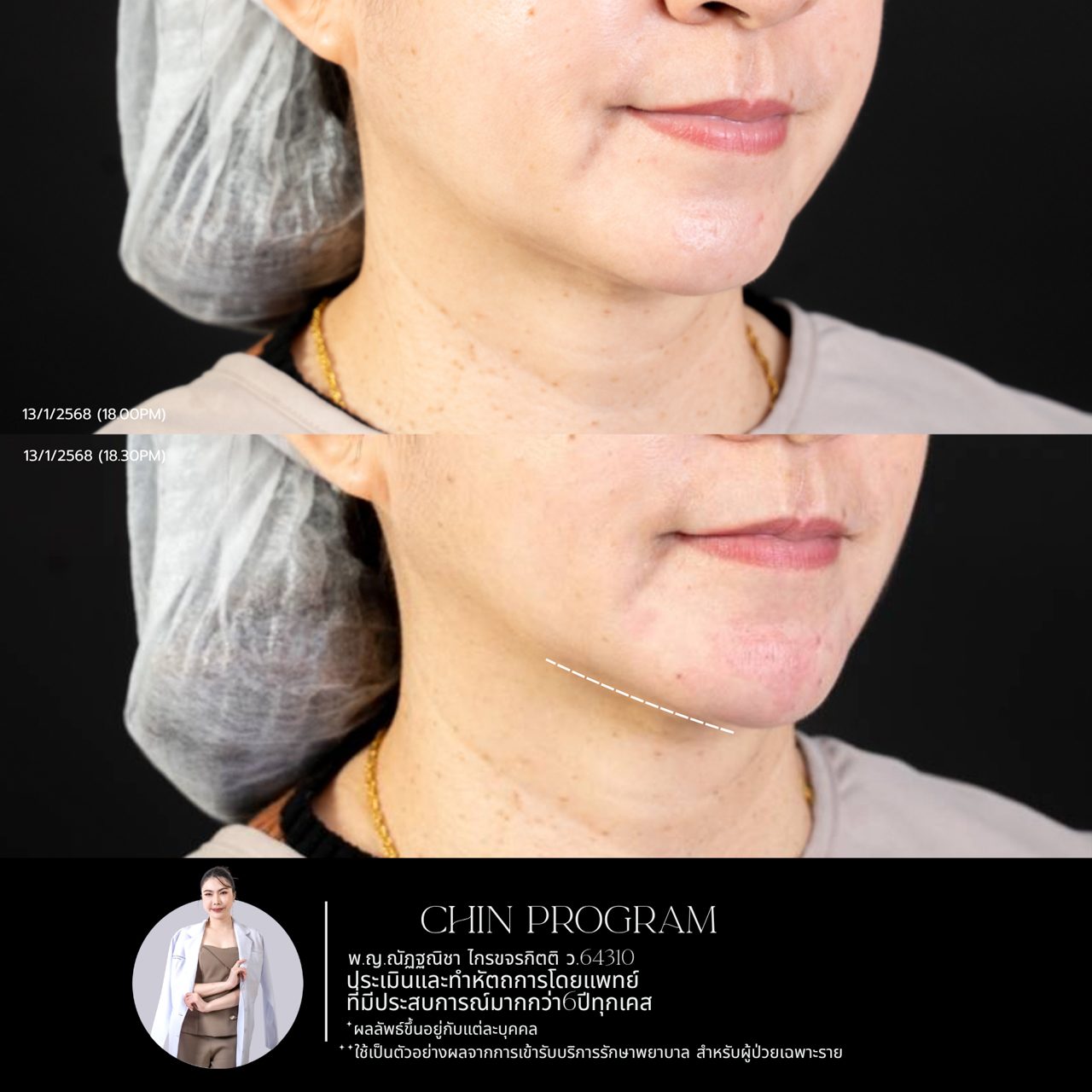 Filler คาง