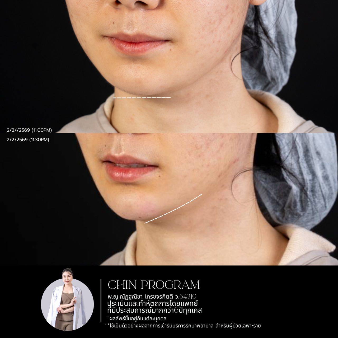 Filler คาง
