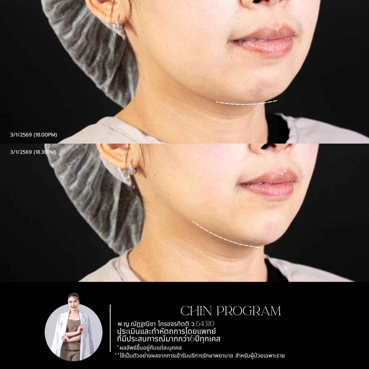 Filler คาง