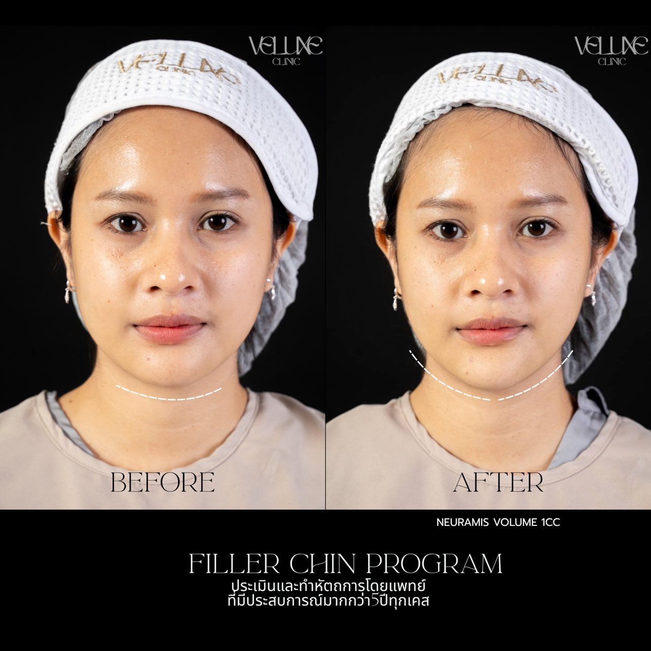 Filler คาง