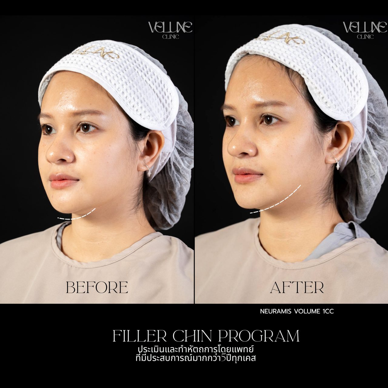 Filler คาง