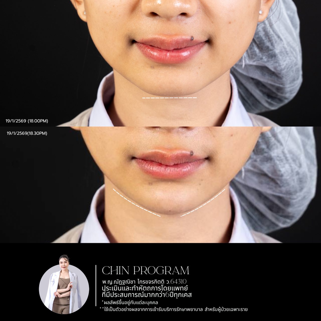 Filler คาง