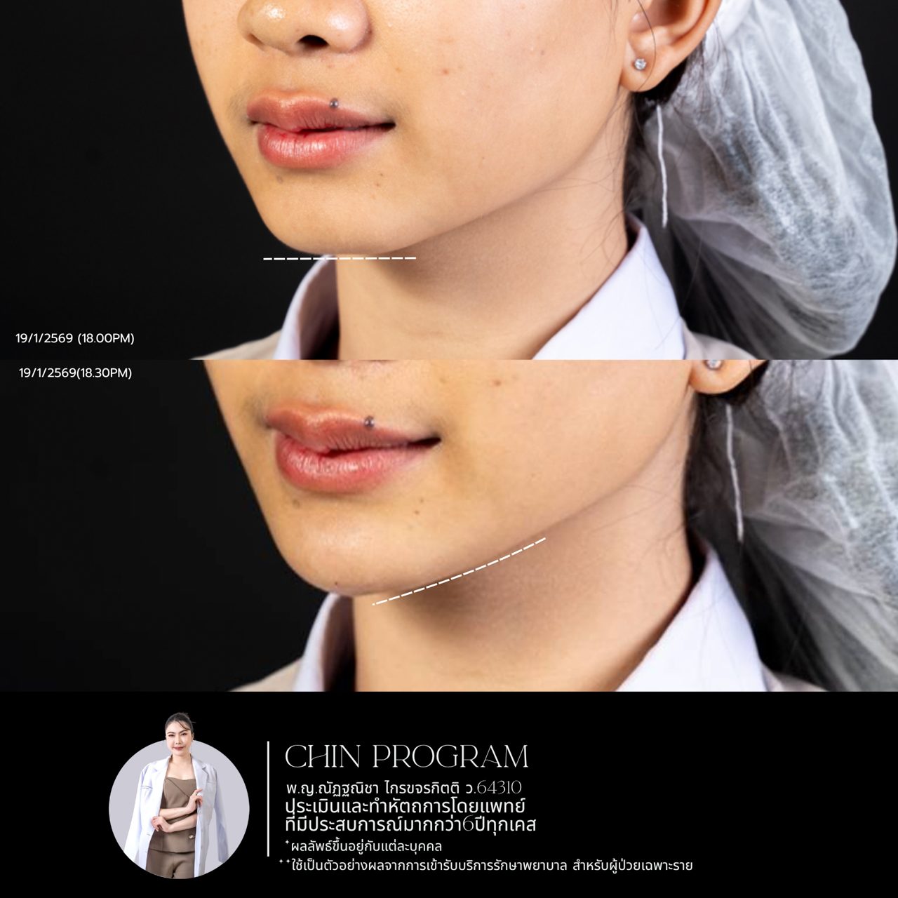 Filler คาง