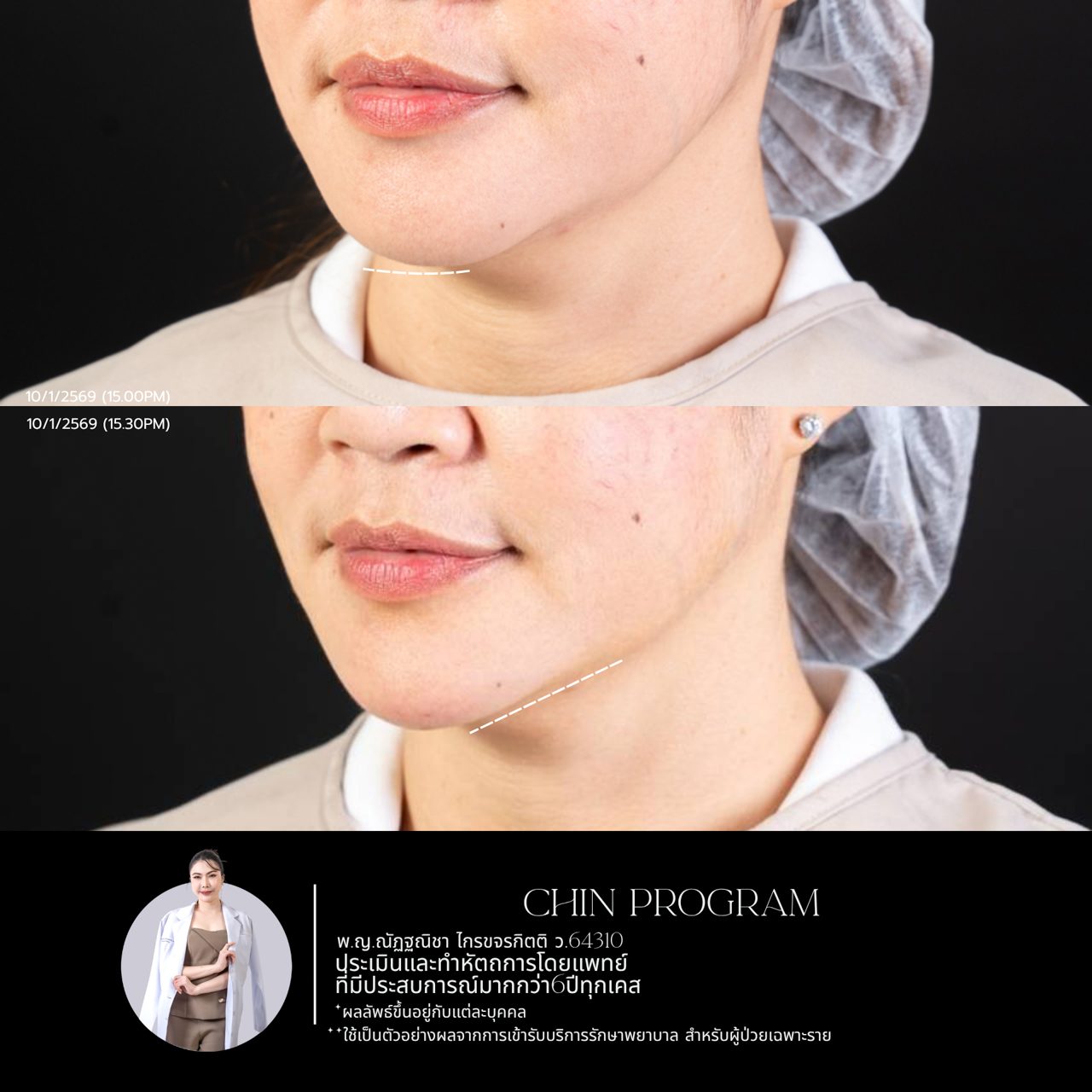 Filler คาง