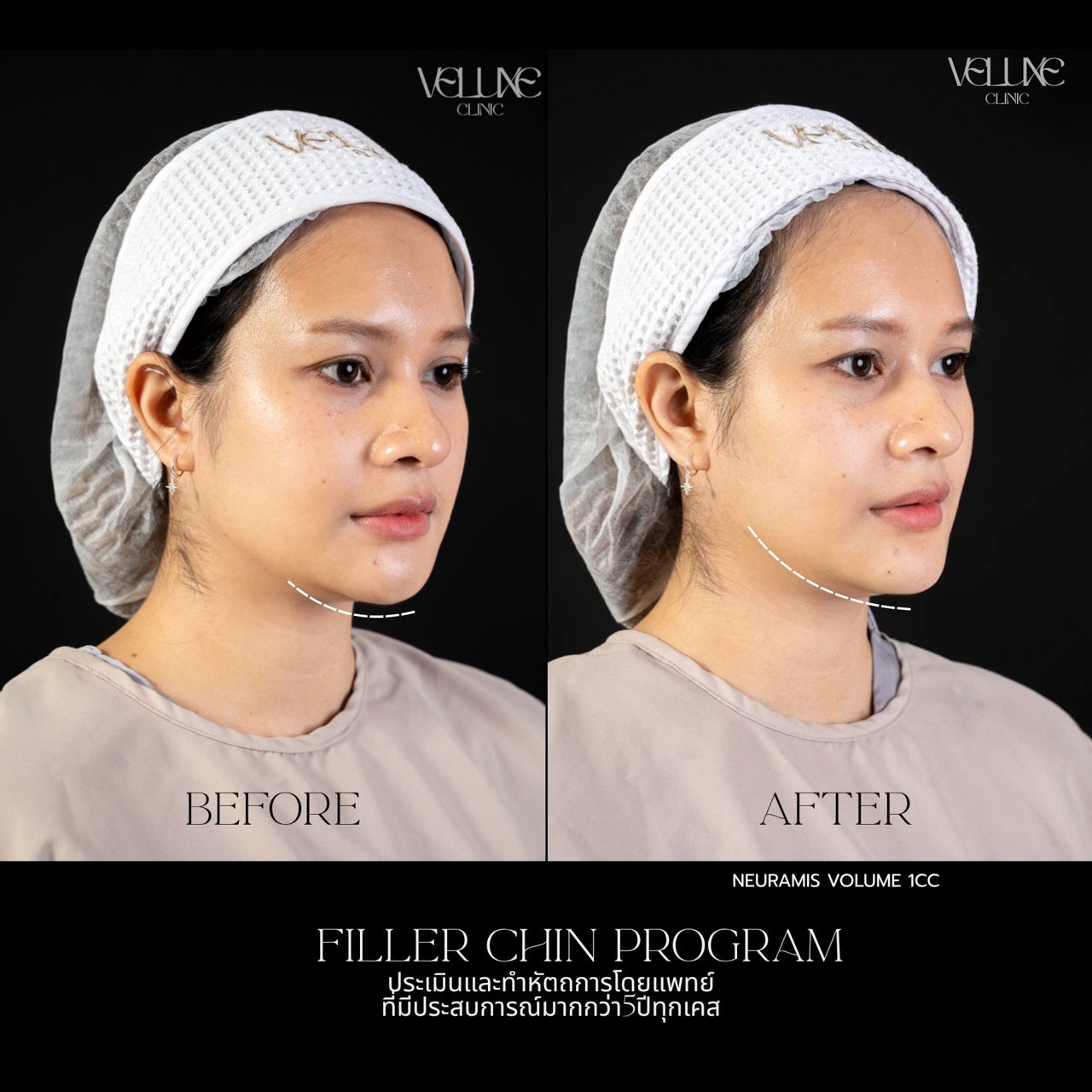 Filler คาง
