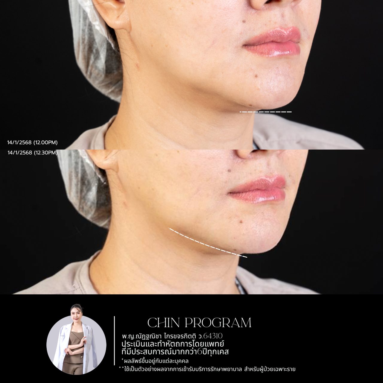 Filler คาง