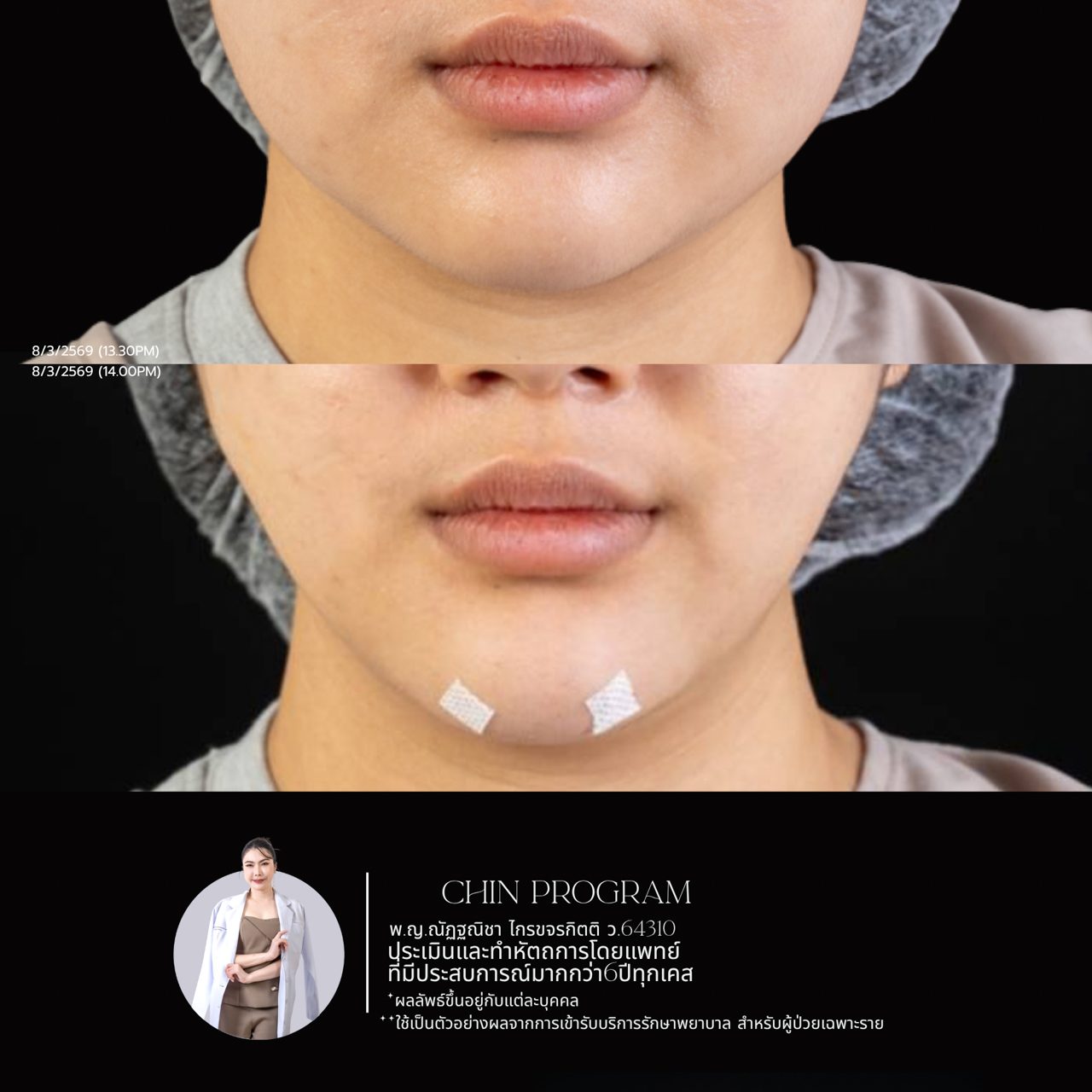 Filler คาง