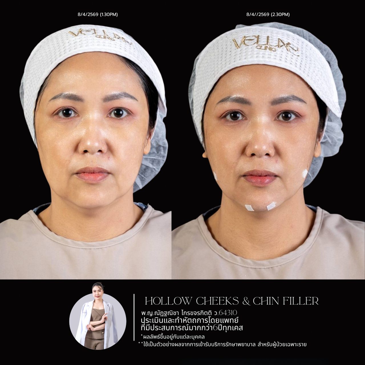 Filler คาง