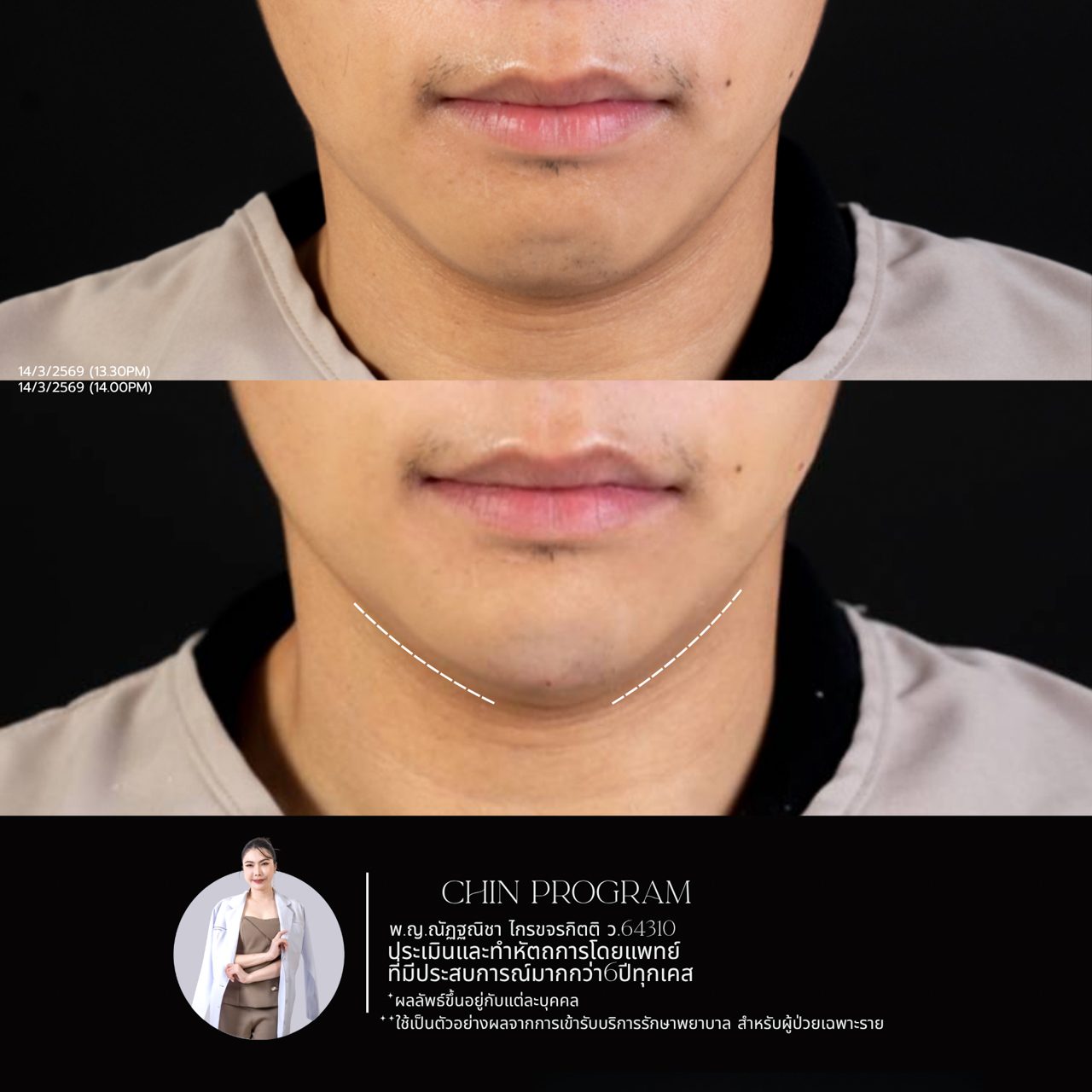 Filler คาง