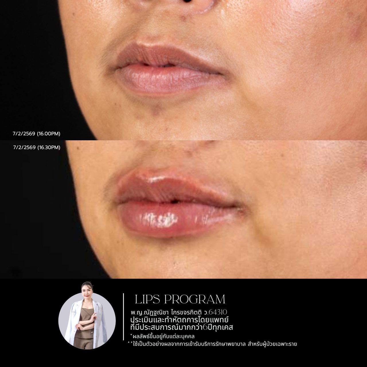 Filler ปาก