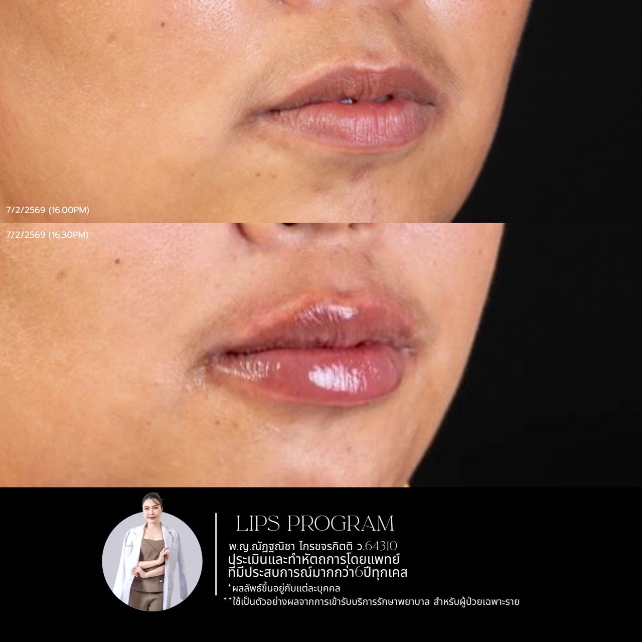 Filler ปาก