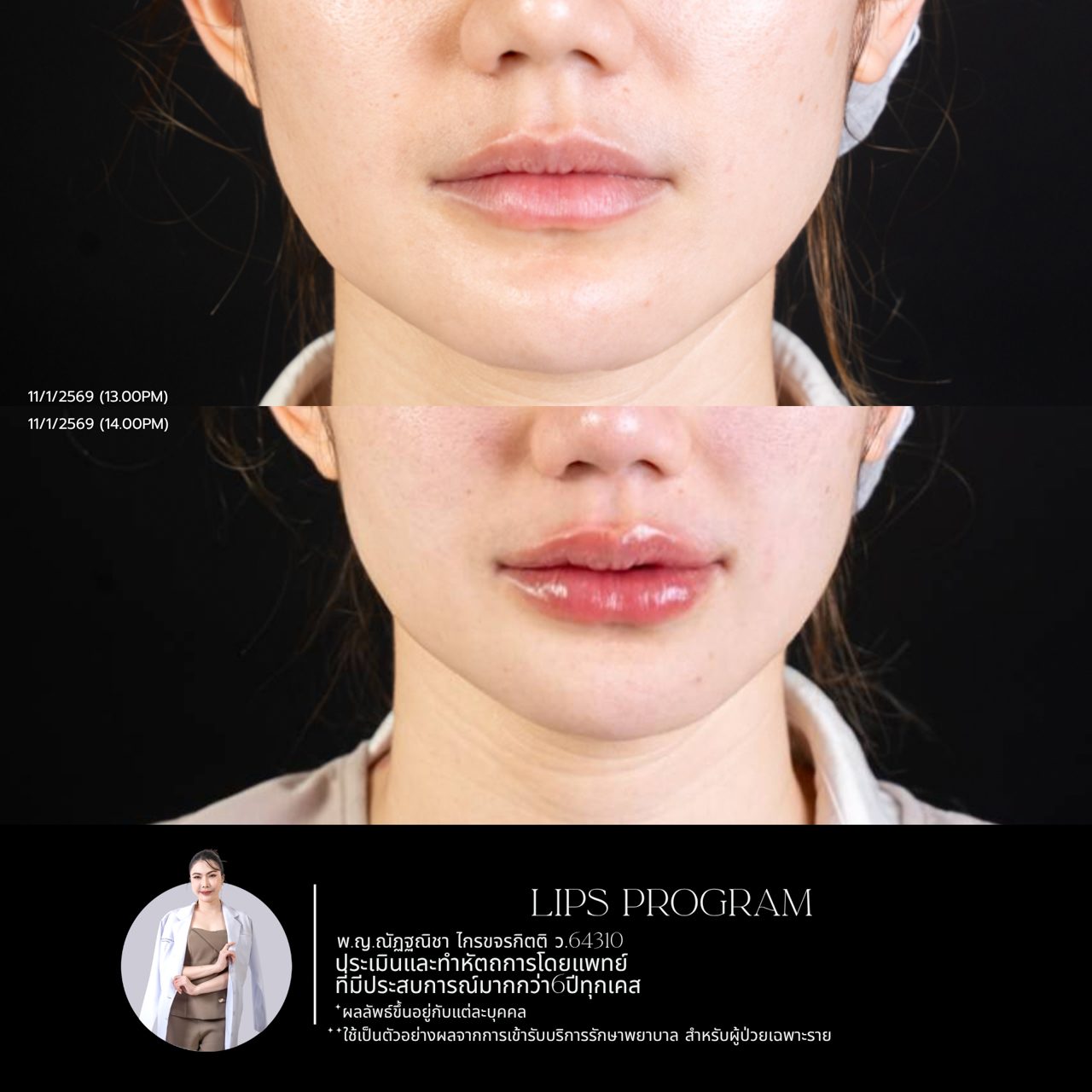 Filler ปาก