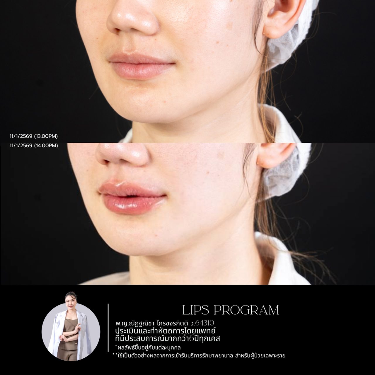 Filler ปาก
