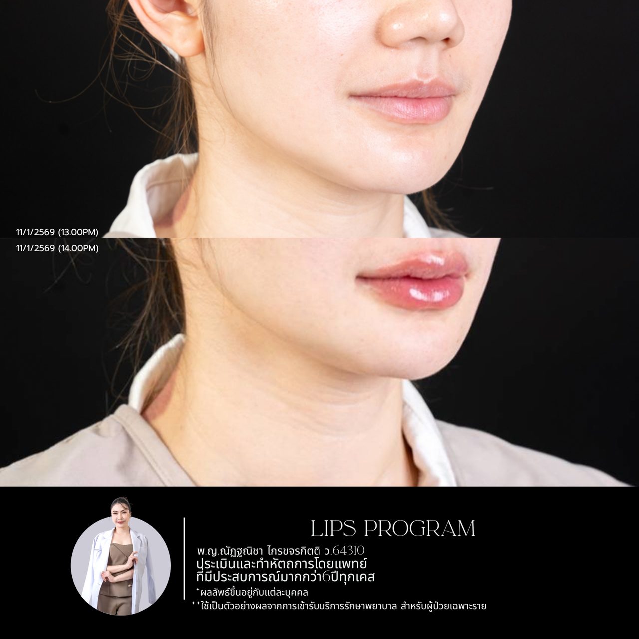 ภาพ Before-After ฟิลเลอร์ริมฝีปาก