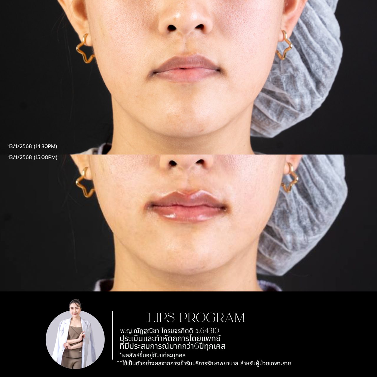 Filler ปาก