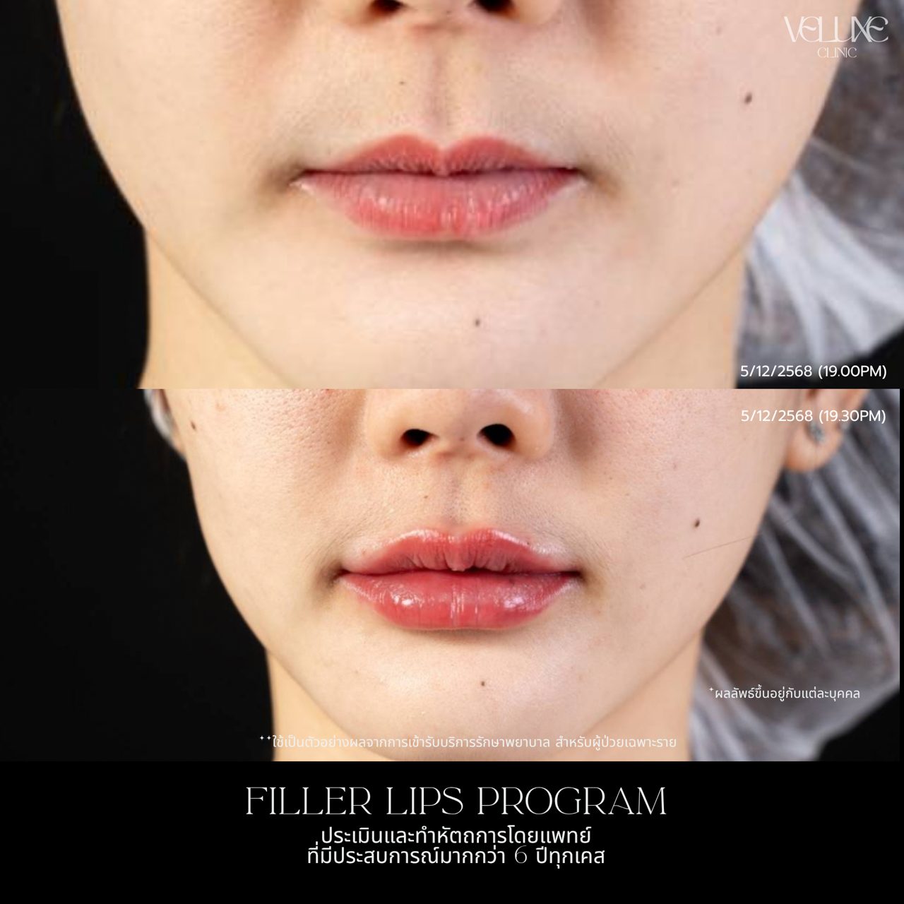 Filler ปาก