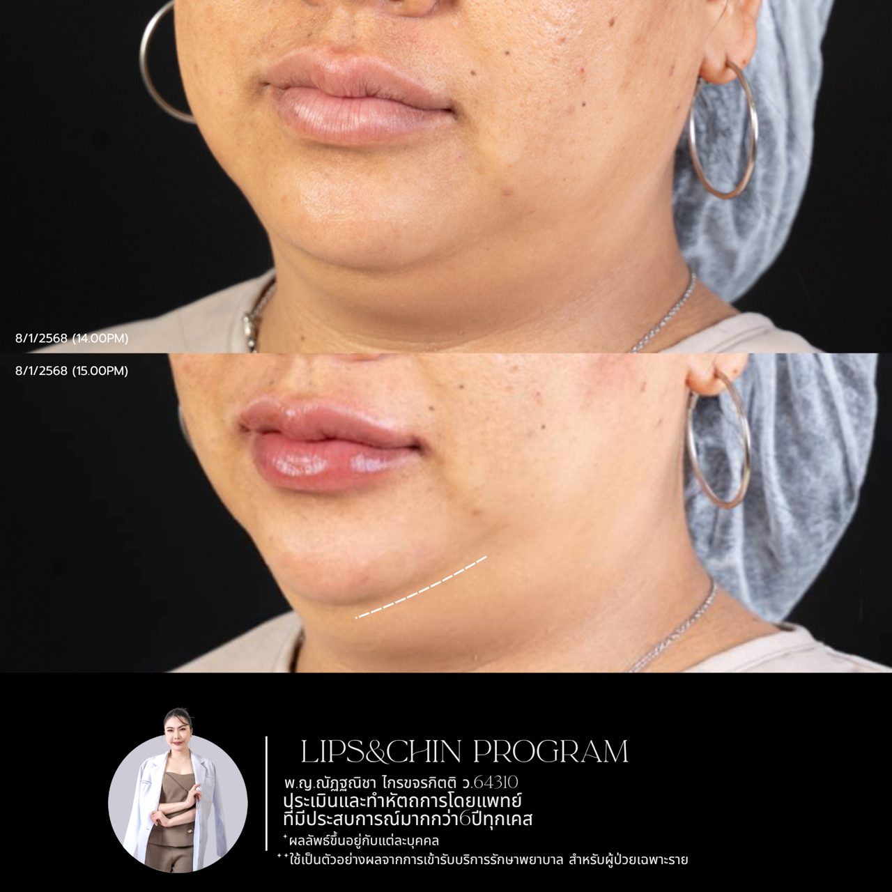 Filler ปาก