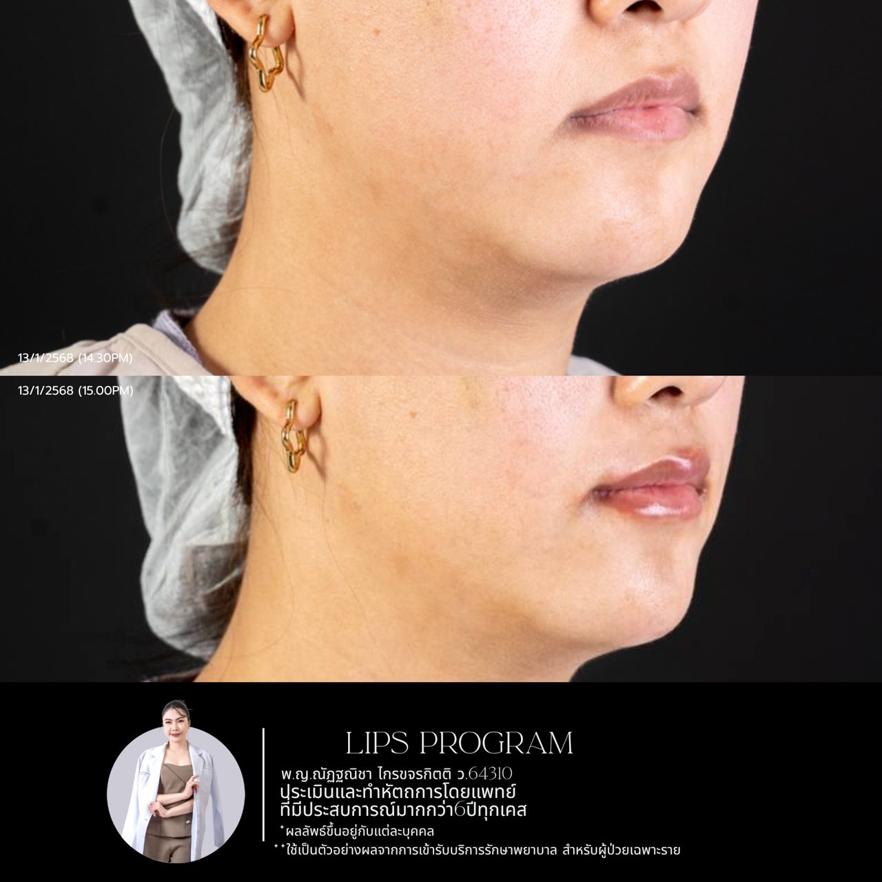 Filler ปาก