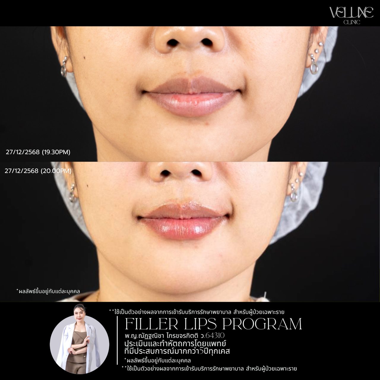 Filler ปาก
