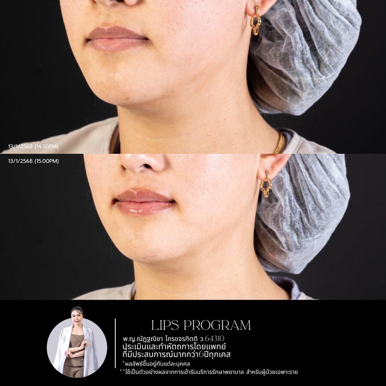 Filler ปาก