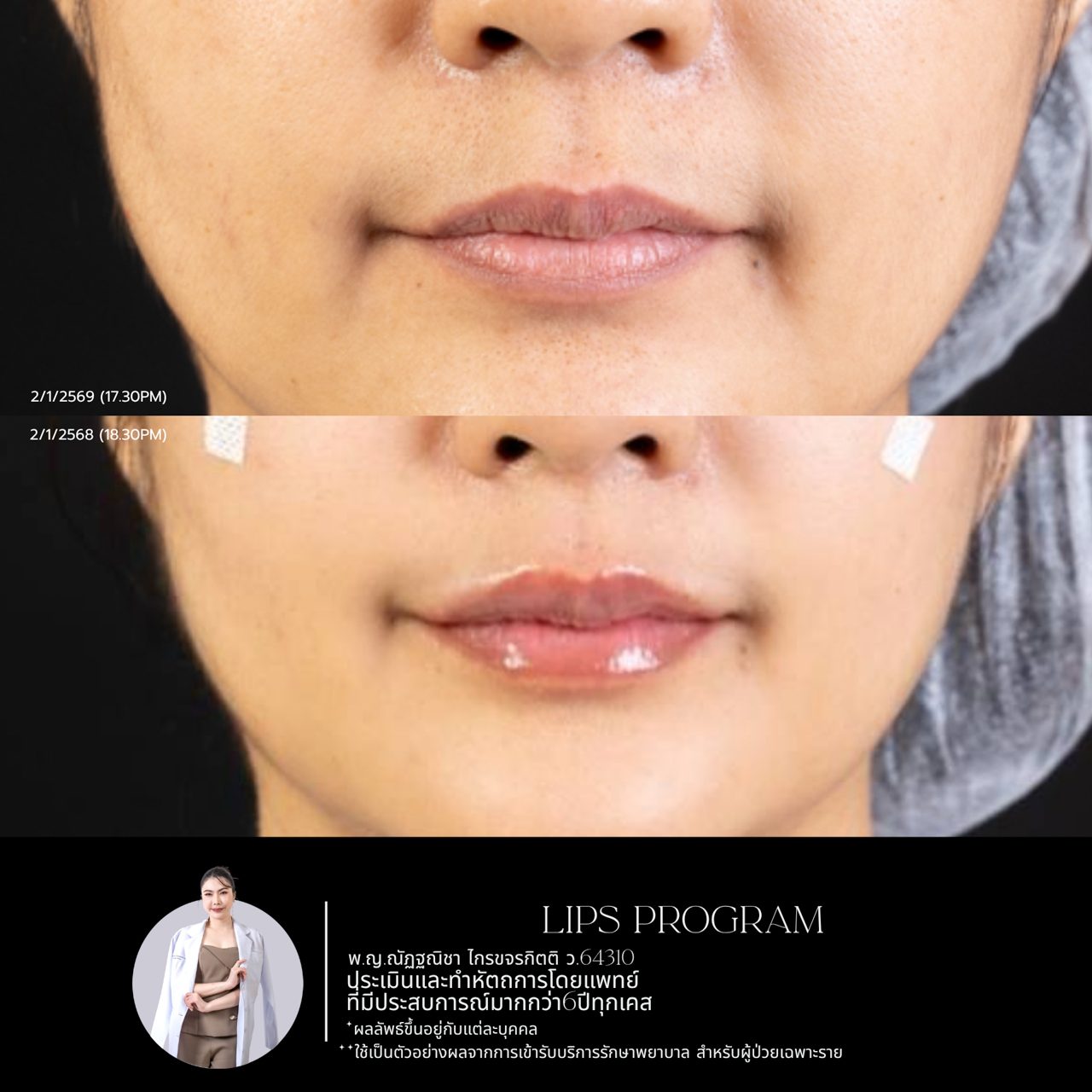 Filler ปาก