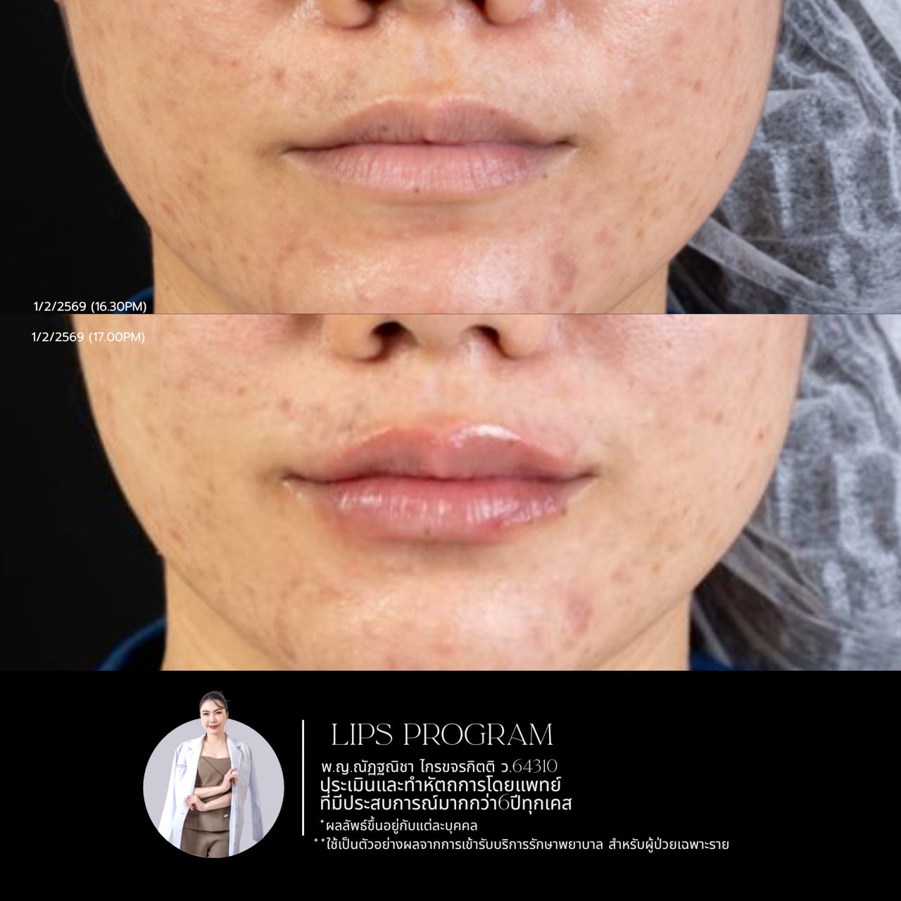 Filler ปาก
