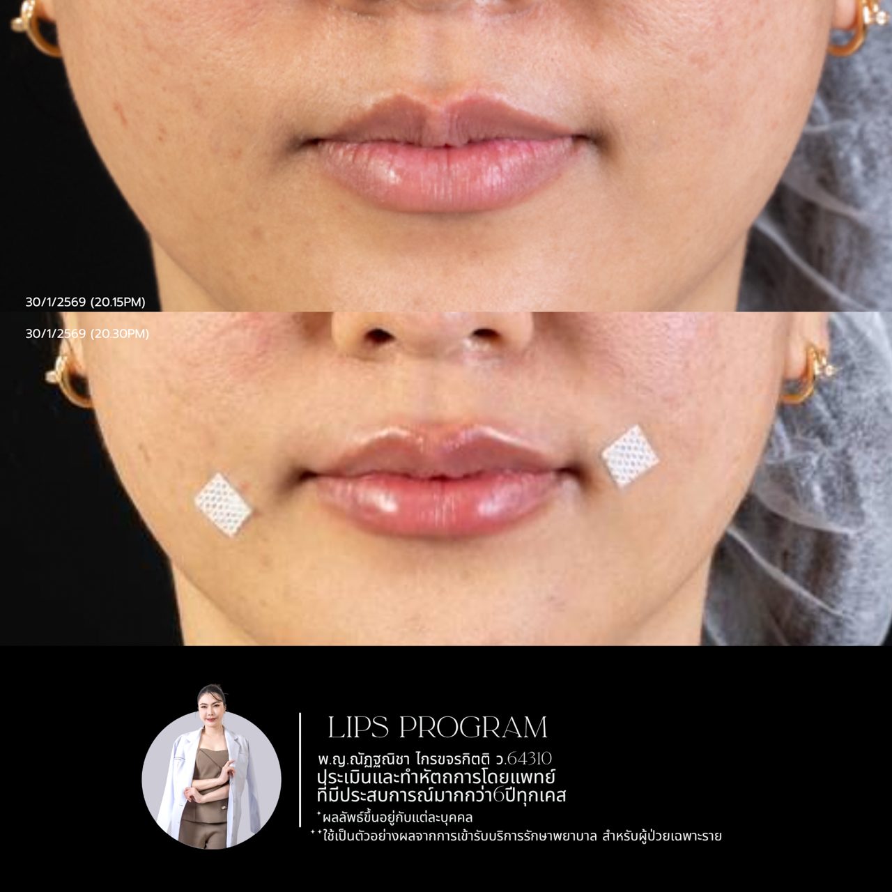 Filler ปาก