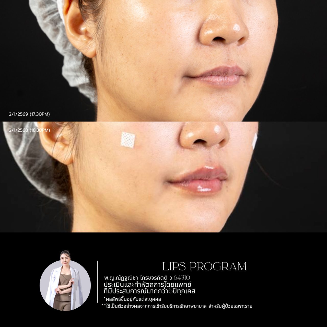 Filler ปาก