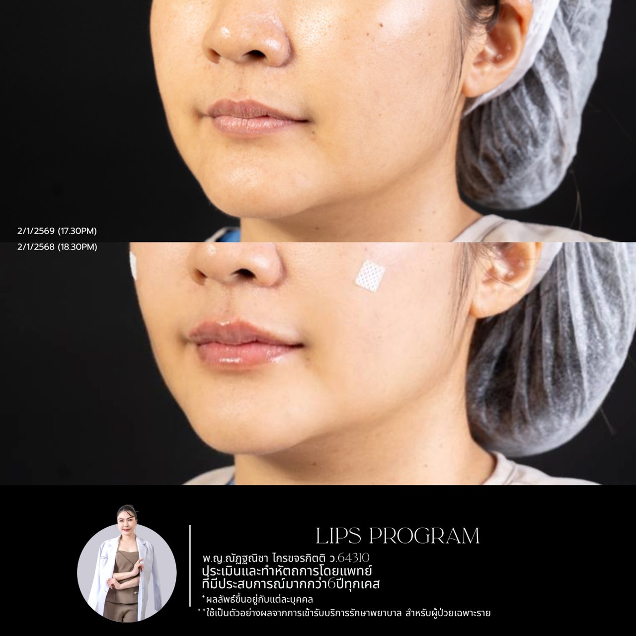 Filler ปาก