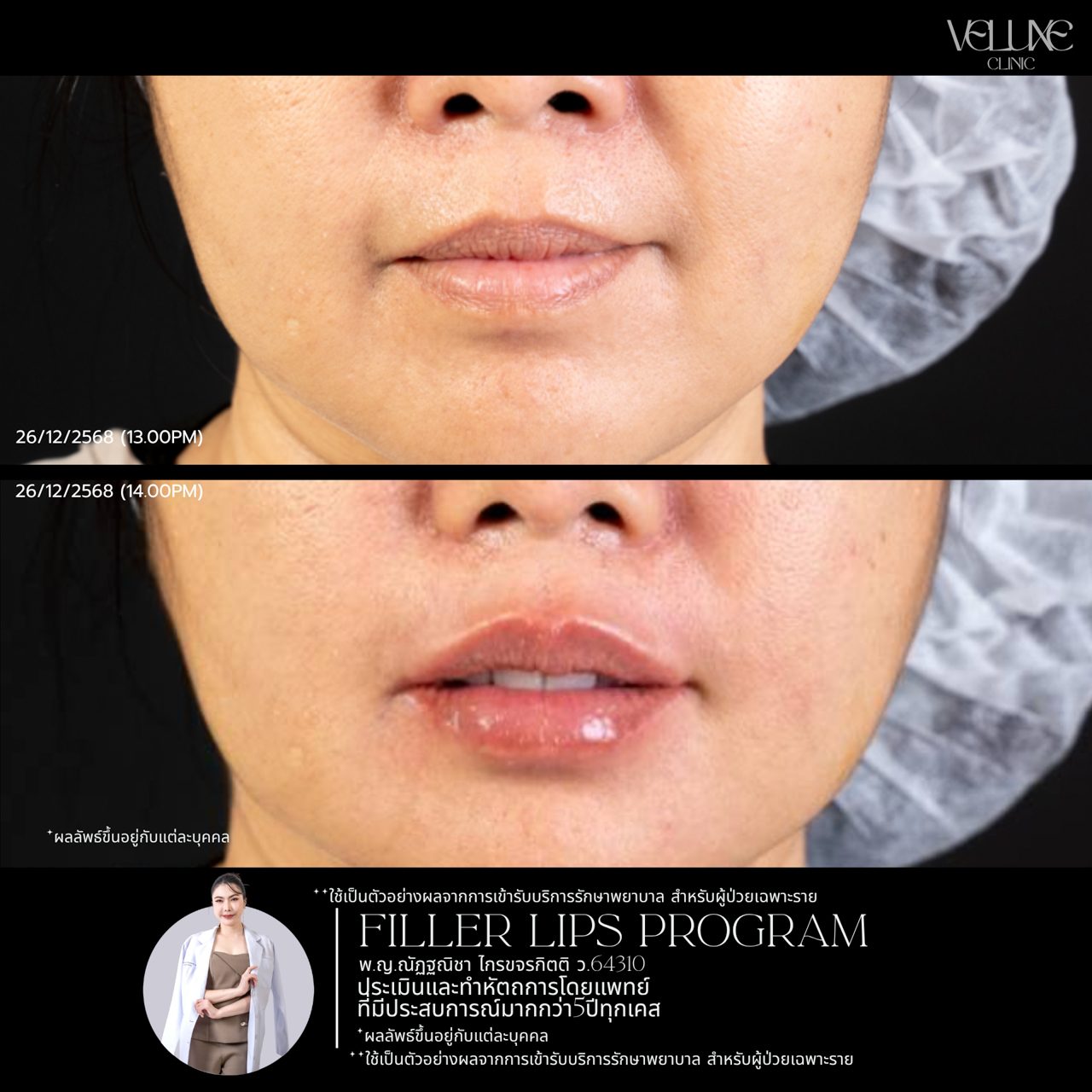 Filler ปาก