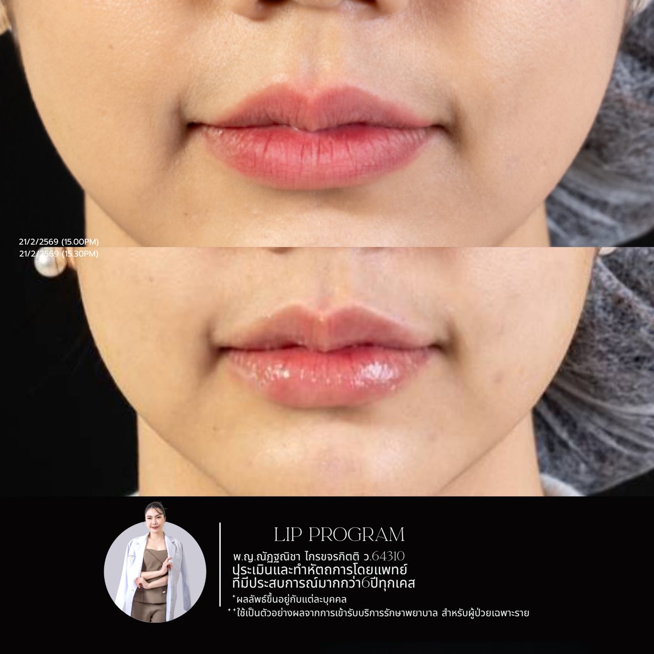 Filler ปาก