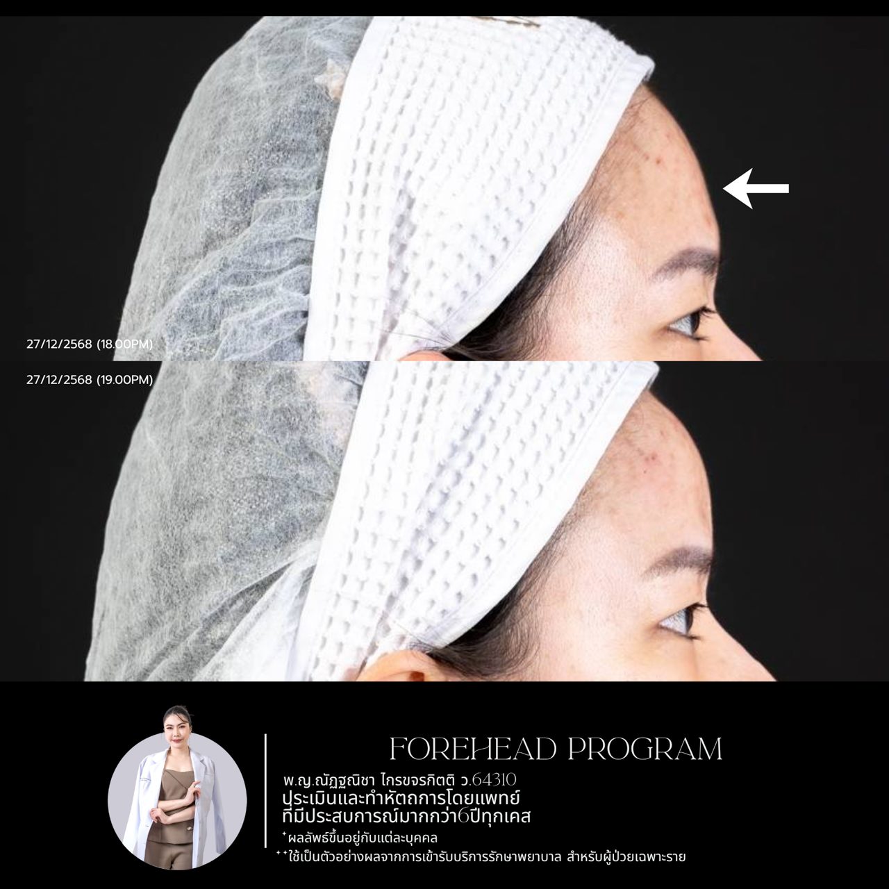 Filler หน้าผาก