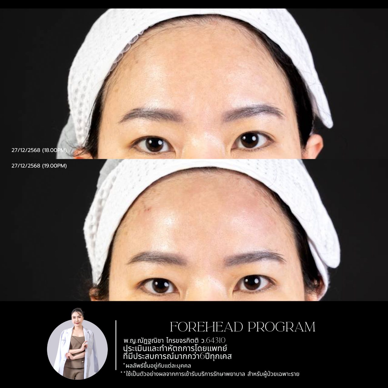 Filler หน้าผาก